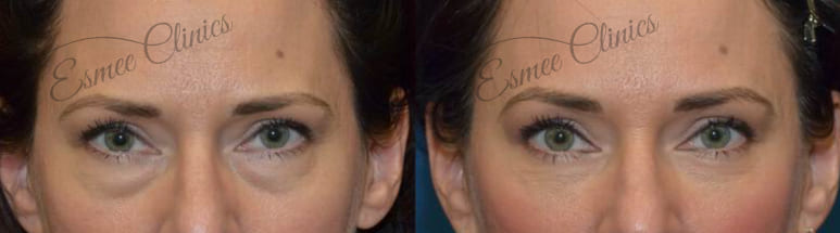 Before and After img